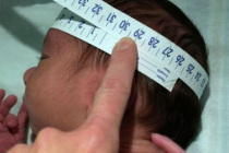 Microcefalia: bebés pueden morir o llevar una vida normal