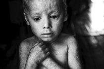 Argentina: Glifosato, cáncer, malformaciones, y niños como principales víctimas